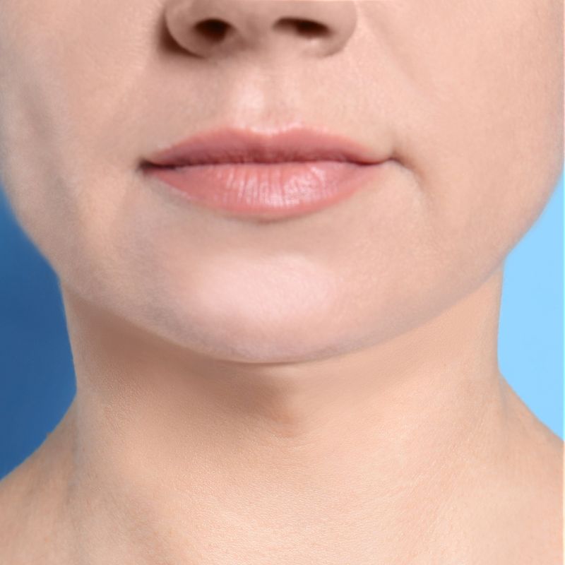 Double chin after treatment