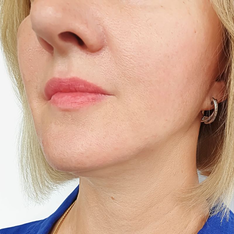 After facial volume loss treatment