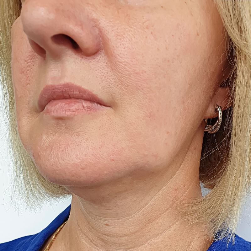 Before facial volume loss treatment