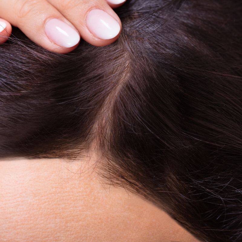 Hair loss treatment after