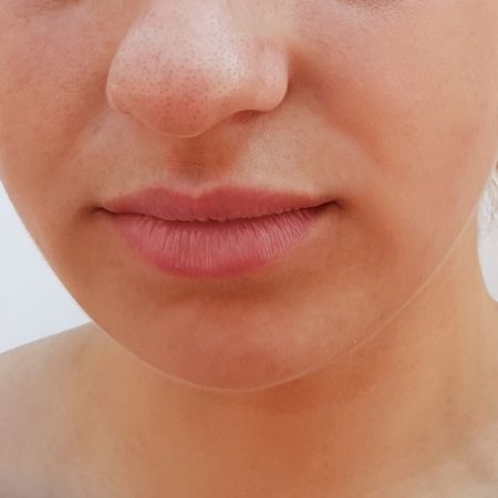 Thin lips after treatment