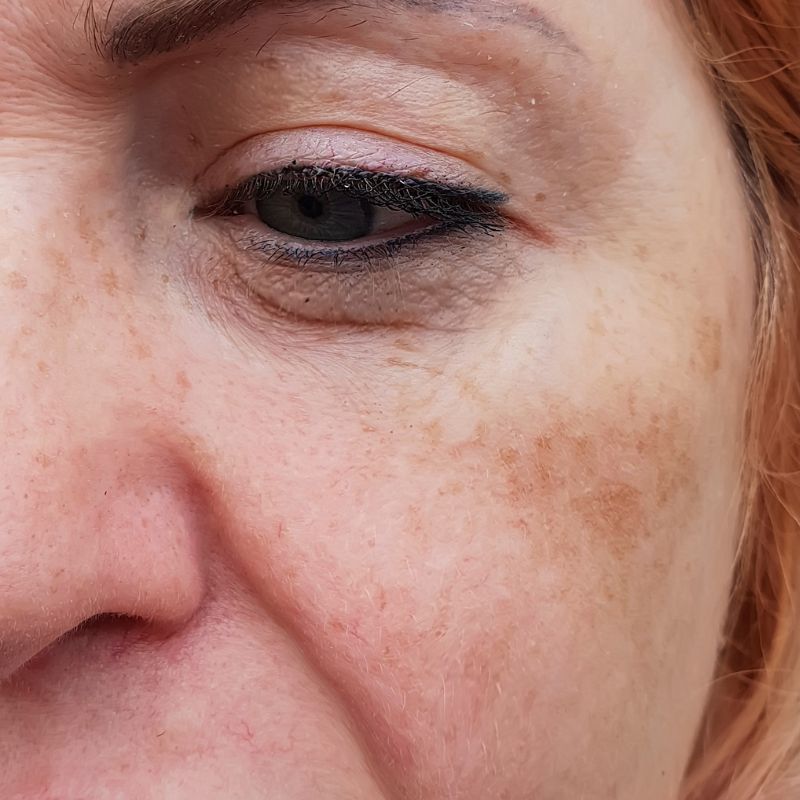 pigmentation before treatment